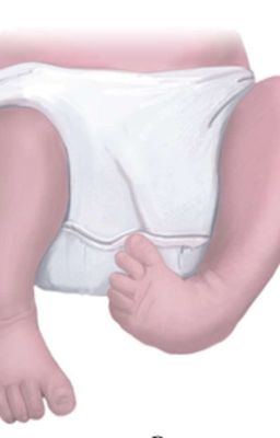 Косолапость - не приговор.